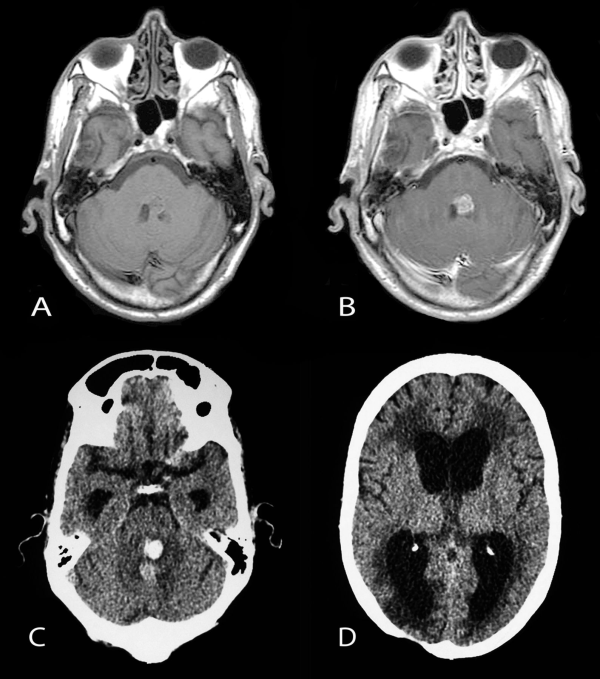 背側外生性腦橋膠質瘤