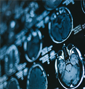 膠質(zhì)母細(xì)胞瘤病因有哪些？