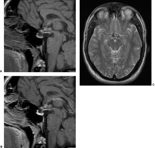 <a href='/bingzhong/xueguanliu/' target='_blank'><u>腦海綿狀血管瘤</u></a>