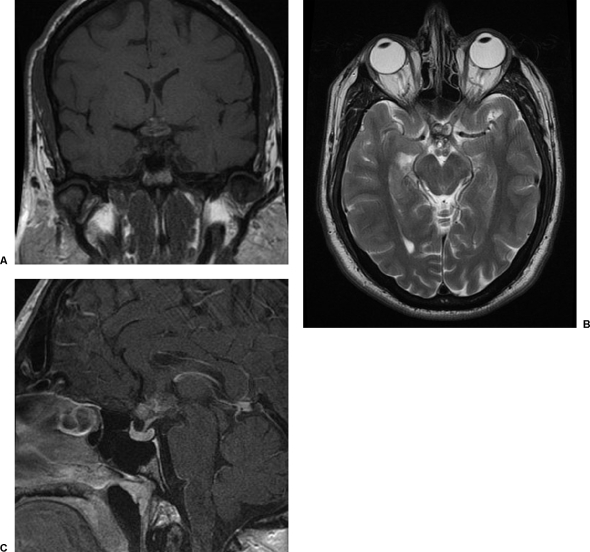 腦部海綿狀血管瘤