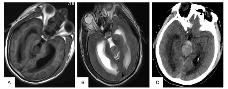 腦脊液分流治療松果體腫瘤