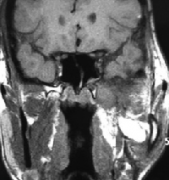 較大三叉神經(jīng)鞘瘤全切，術(shù)后7年沒有復(fù)發(fā)