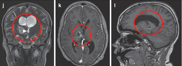 丘腦膠質(zhì)瘤