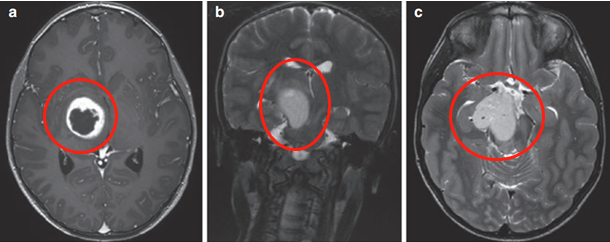 丘腦膠質(zhì)瘤