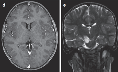 丘腦膠質(zhì)瘤