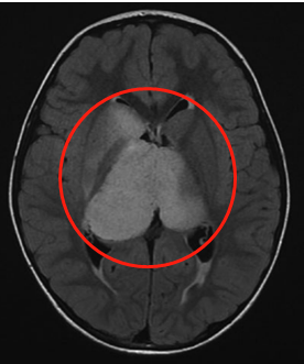 國際神外專家談丘腦膠質(zhì)瘤的綜合治療及案例展示