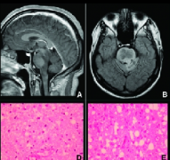 腦部膠質(zhì)瘤四級死亡癥狀？惡性腦膠質(zhì)瘤有哪些癥狀表現(xiàn)？