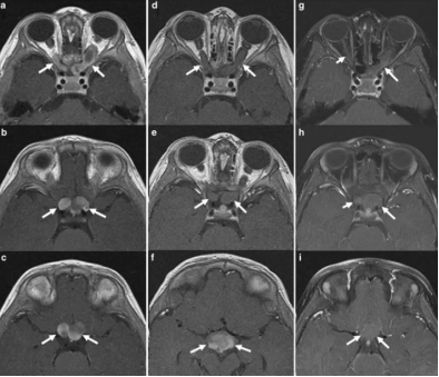 視神經(jīng)膠質(zhì)瘤能做手術(shù)嗎?會導致失明嗎?