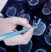 治療兒童腦膠質(zhì)瘤醫(yī)院有哪些？髓母細(xì)胞瘤能治好嗎？