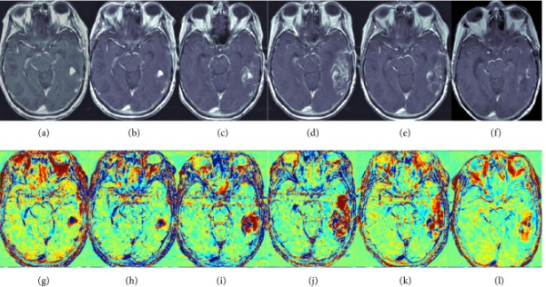 腦膠質(zhì)瘤的治療方法