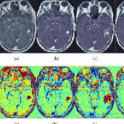 腦膠質(zhì)瘤復(fù)發(fā)怎么辦？膠質(zhì)瘤復(fù)發(fā)后需手術(shù)嗎？