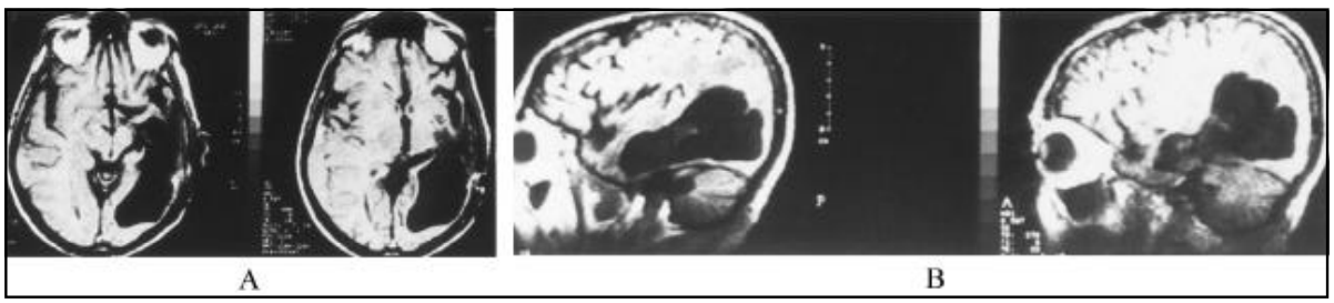 惡性腦膜瘤需要做手術(shù)嗎？