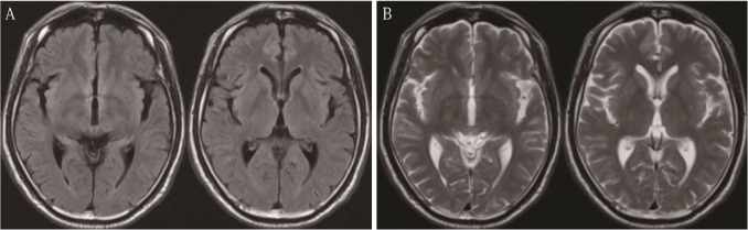 <a href='/bingzhong/sgtqzl/' target='_blank'><u>松果體區(qū)腫瘤</u></a>