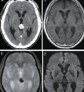 松果體區(qū)生殖細(xì)胞腫瘤好治嗎？內(nèi)鏡聯(lián)合治療案例報(bào)告一則