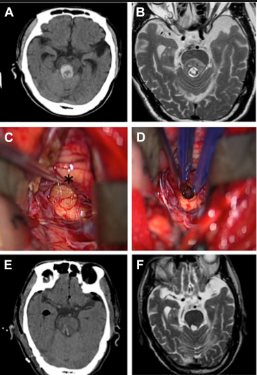 腦干海綿狀血管瘤如何治療