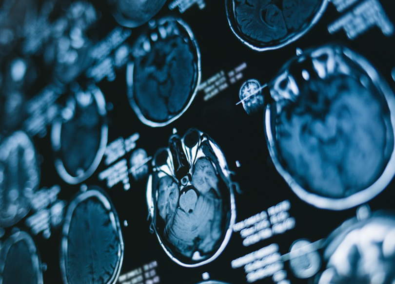 大腦凸面腦膜瘤手術(shù)