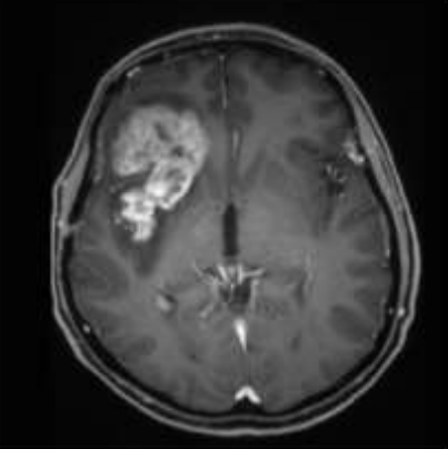 間變性膠質(zhì)瘤三級(jí)術(shù)后不放化療可以嗎？