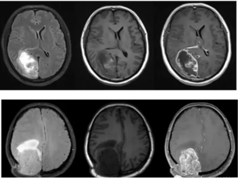 膠質(zhì)瘤復(fù)發(fā)診斷：是惡性進(jìn)展還是放射性壞死？