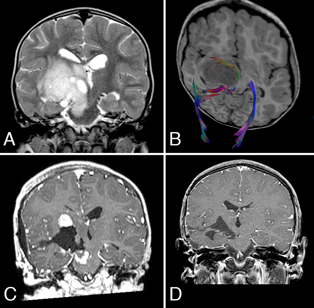 丘腦膠質(zhì)瘤的外科治療