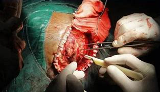 丘腦膠質(zhì)瘤