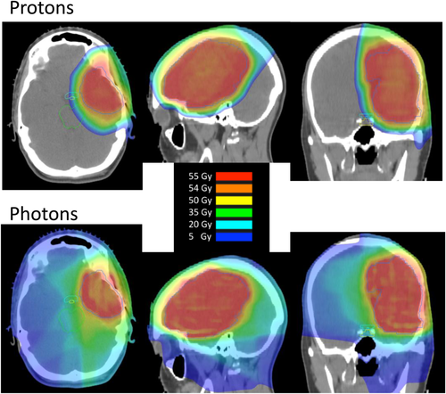 低級別膠質(zhì)瘤質(zhì)子治療合適嗎？