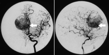 腦膜瘤術(shù)前