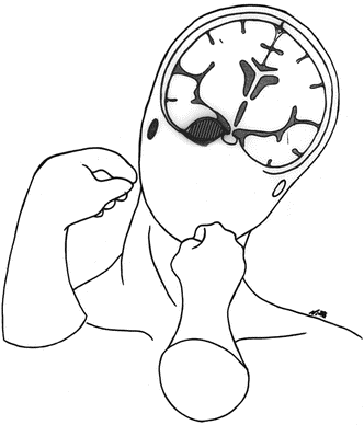 三叉神經(jīng)鞘瘤是大手術(shù)嗎？