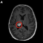 病灶多、位置深、易復(fù)發(fā)，不開(kāi)顱也能“消滅”膠質(zhì)瘤，國(guó)際前沿技術(shù)LITT你知道了嗎？