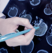 少枝膠質(zhì)瘤嚴(yán)重嗎？預(yù)后影響因素有哪些？