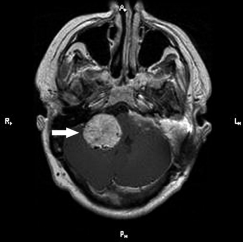 神經(jīng)纖維瘤案例