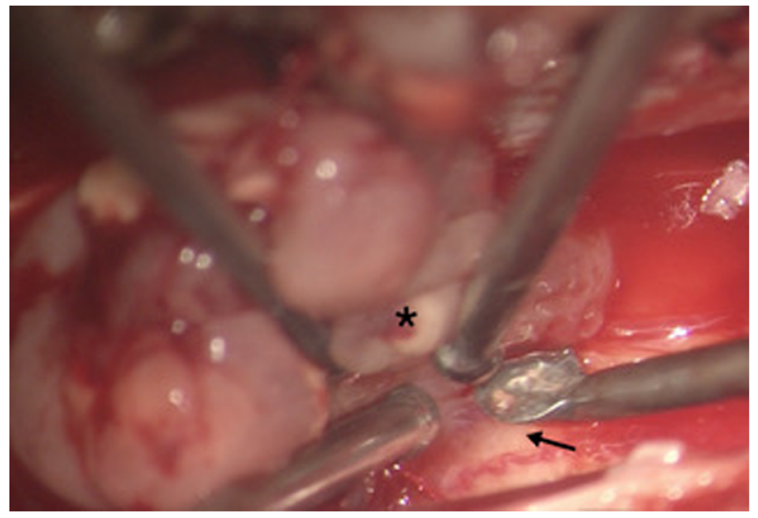 毛細(xì)胞星形細(xì)胞瘤手術(shù)治療