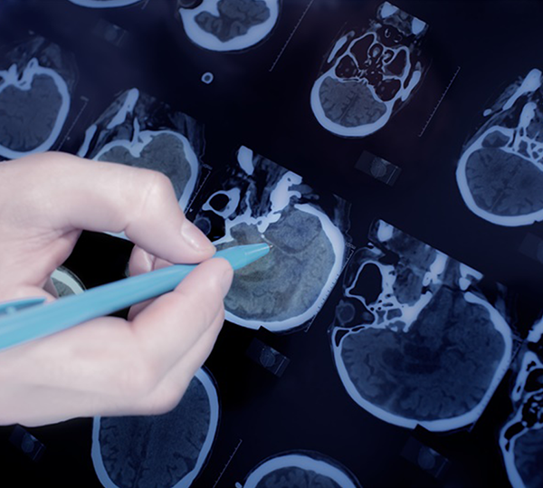 面對(duì)腦干膠質(zhì)瘤束手無(wú)策？順利全切后10年以上沒(méi)有復(fù)發(fā)案例3則