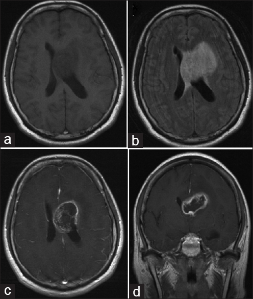 膠質(zhì)母細(xì)胞瘤治療須知：腦膠質(zhì)瘤多長(zhǎng)時(shí)間放化療一個(gè)周期？