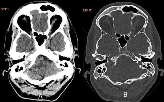 少見的頸靜脈孔區(qū)腦膜瘤病例一則