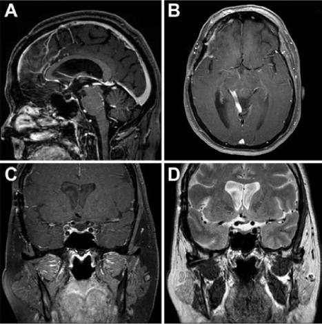視神經(jīng)下丘腦海綿狀血管瘤好治嗎？