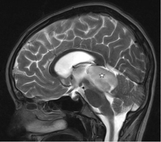 INC國際專家解析：小兒原發(fā)性顱內(nèi)間變性神經(jīng)節(jié)膠質(zhì)瘤