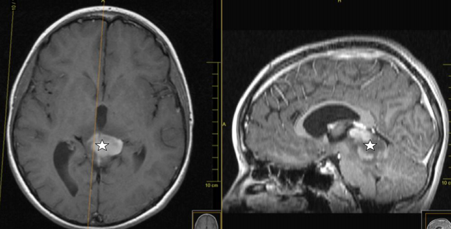 小兒膠質(zhì)瘤