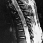 脊髓硬膜內(nèi)血管畸形是什么？如何治療？