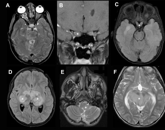 視神經(jīng)膠質(zhì)瘤能治好嗎？1型神經(jīng)纖維瘤病中的視神經(jīng)膠質(zhì)瘤嚴(yán)重嗎？