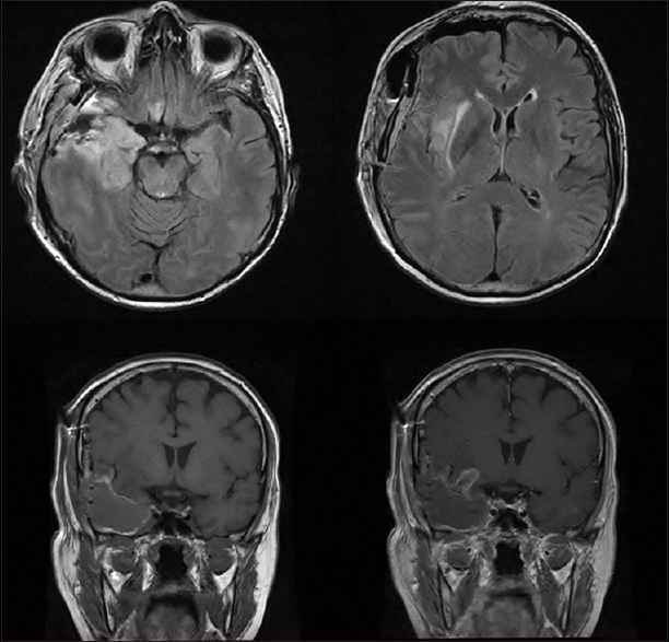 切除四級腦膠質(zhì)瘤又遇病毒性腦炎，腦瘤患者的求生之路