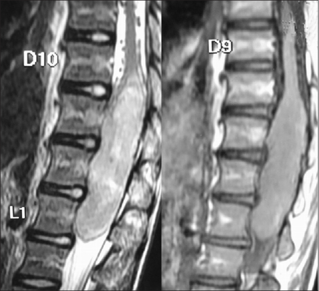 如何治療少見的脊髓內(nèi)神經(jīng)節(jié)細(xì)胞膠質(zhì)瘤更為合適？