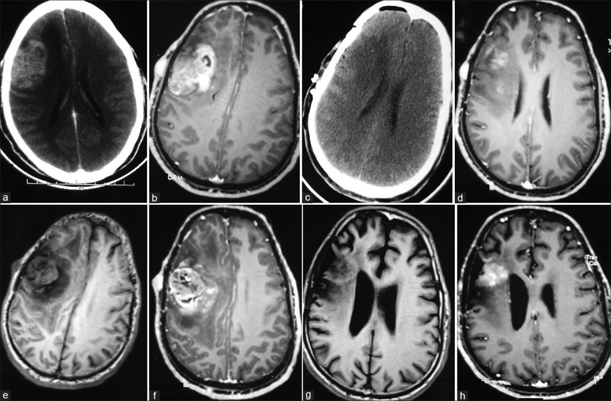 神經(jīng)膠質(zhì)瘤