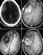神經(jīng)纖維瘤患者得腦瘤的概率高嗎？神經(jīng)膠質(zhì)瘤預(yù)后如何