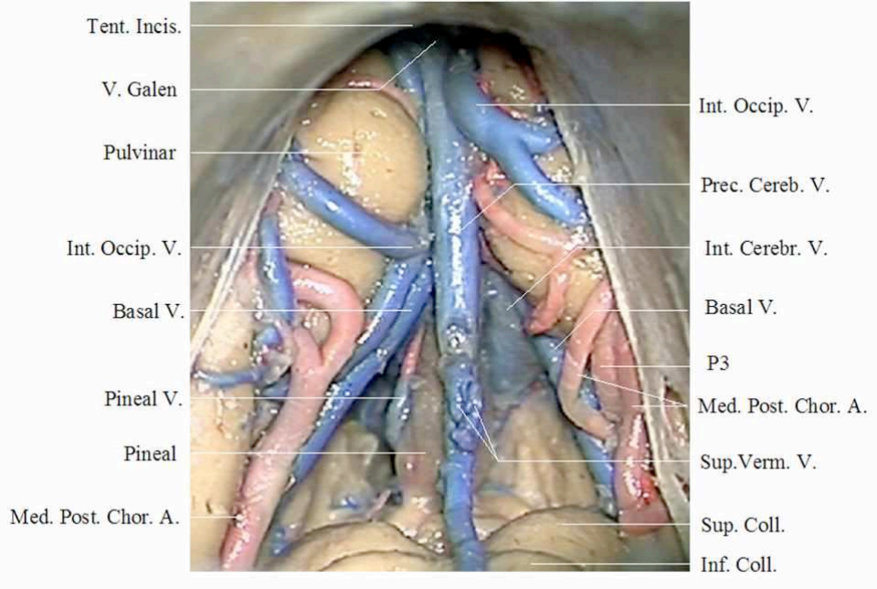 松果體區(qū)腫瘤