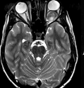 視神經(jīng)膠質(zhì)瘤的當(dāng)前治療方法