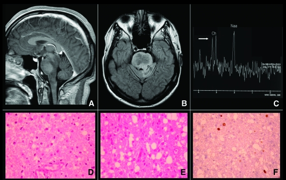 腦膠質(zhì)瘤死于四級癥狀？惡性腦膠質(zhì)瘤的癥狀是什么？