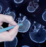 DIPG、局灶性腦干膠質(zhì)瘤建議手術(shù)切除嗎？