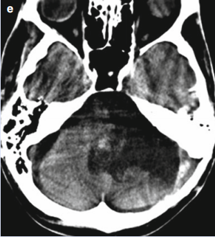 聽神經(jīng)瘤手術(shù)風(fēng)險(xiǎn)大嗎？巨型聽神經(jīng)瘤7次復(fù)發(fā)并壓迫腦干，如何挽救危重患者?