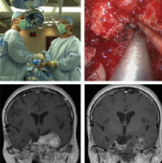 斜坡和巖斜區(qū)惡性腦瘤治療策略分析