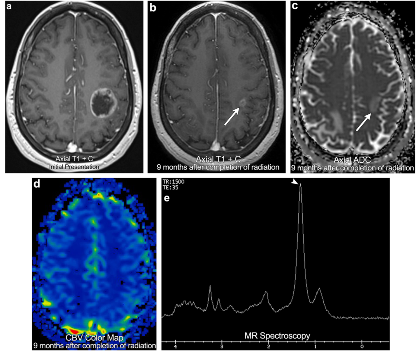 高級(jí)別膠質(zhì)瘤與腦轉(zhuǎn)移瘤的治療反應(yīng)標(biāo)準(zhǔn)